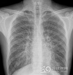 肺泡微结石症