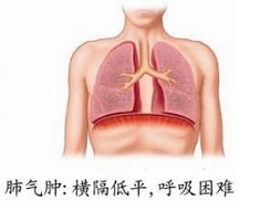 肺气肿