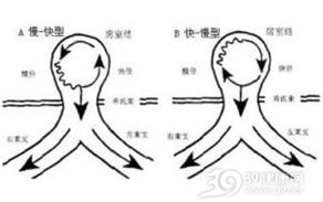 房室结折返性心动过速