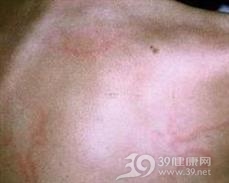 风湿性边缘性红斑