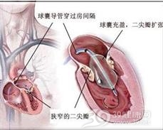 风湿性二尖瓣狭窄