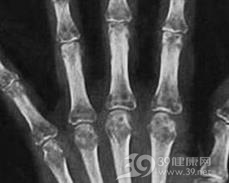 反射性交感神经营养不良综合征