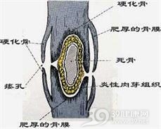 放射性脊髓病
