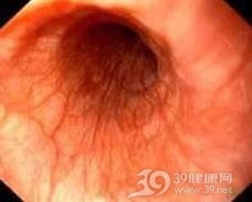 放射性食管炎