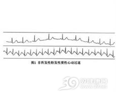 非阵发性窦性心动过速