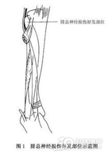腓总神经卡压症