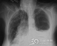 肺组织细胞增生症