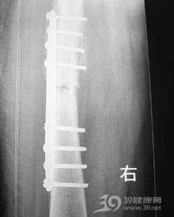 股骨髁上骨折
