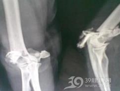 肱骨上端骨骺分离