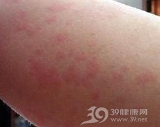 过敏性血管炎