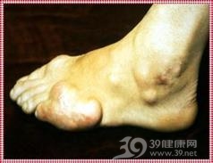 高尿酸血症肾病