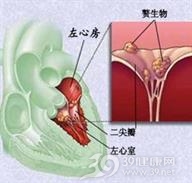 感染性心内膜炎
