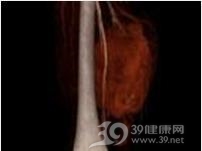 骨外尤文氏瘤
