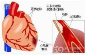 高血压性心肌病
