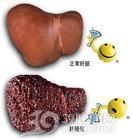 肝炎后肝硬化