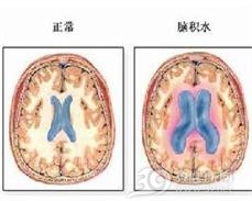 高原脑水肿