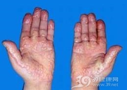 高脂蛋白血症Ⅴ型