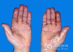高脂蛋白血症Ⅰ型
