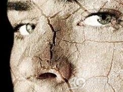 干燥综合征