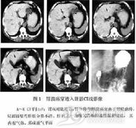 后壁穿孔性溃疡
