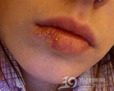 狐惑