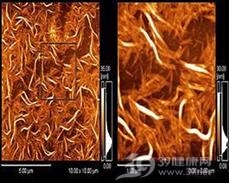 混合型卟啉病