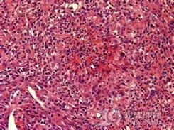 坏死性结节病样肉芽肿病