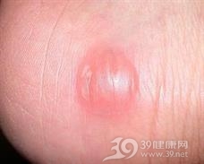 红细胞生成性卟啉病