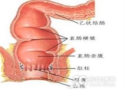 结肠粪性穿孔