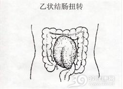 结肠扭转