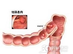 结肠息肉