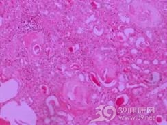 近端(Ⅱ型)肾小管性酸中毒