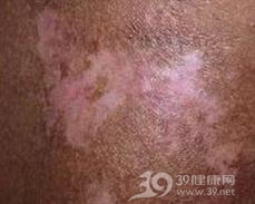结缔组织病