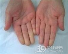交感神经链综合征