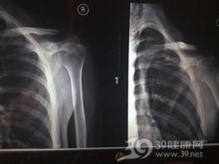 肩胛骨体部骨折