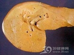 酒精肝
