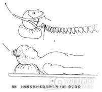 绞架性骨折或外伤性枢椎椎弓骨折