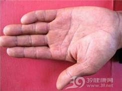 结节性红斑