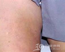 结节性液化性脂膜炎