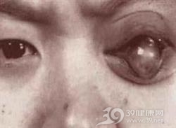 角膜葡萄肿