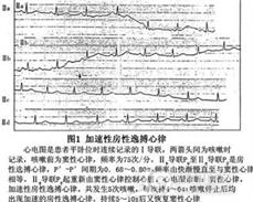 加速性房性逸搏心律