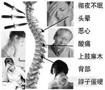 脊髓型颈椎病