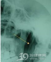 茎突综合征