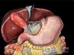 急性胆囊炎