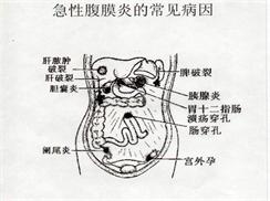 急性腹膜炎