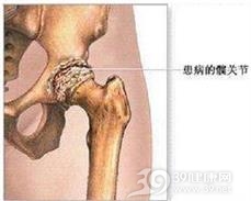 急性化脓性脊髓炎