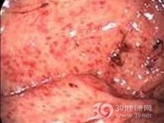 急性化脓性胃炎