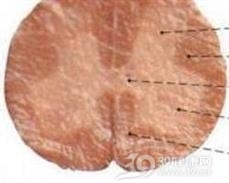 急性坏死出血性脑脊髓炎