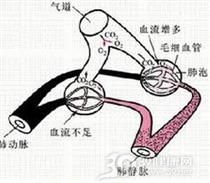 急性呼吸衰竭