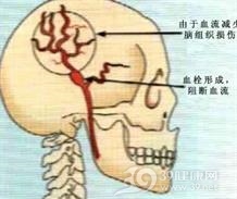 急性和亚急性硬脑膜下血肿